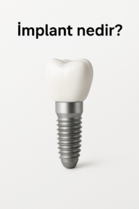 İmplant diş nedir ve nasıl yapılır görseli, çene kemiğine yerleştirilen implant vidaları